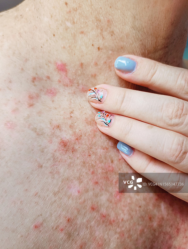 女人手挠胸部和颈部，皮肤有异样图片素材