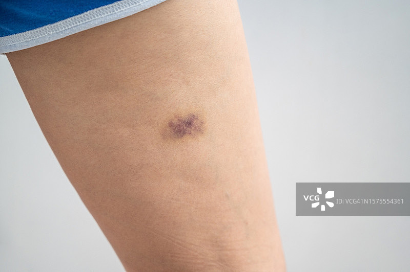 皮肤上的瘀伤特写：随着年龄增长，皮肤变薄导致更容易出现瘀伤图片素材