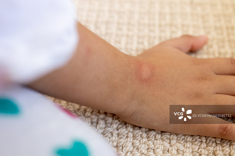 年轻混血女性手部蚊虫叮咬肿胀特写图片素材