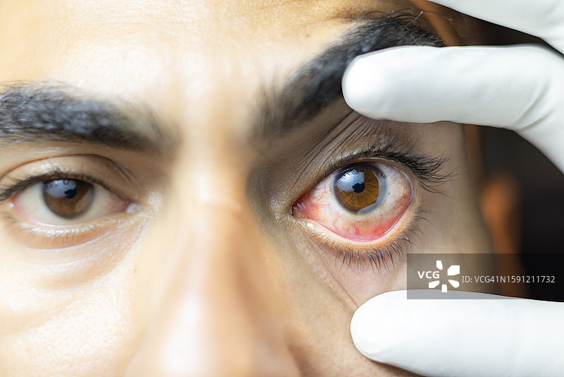 结膜炎图片素材