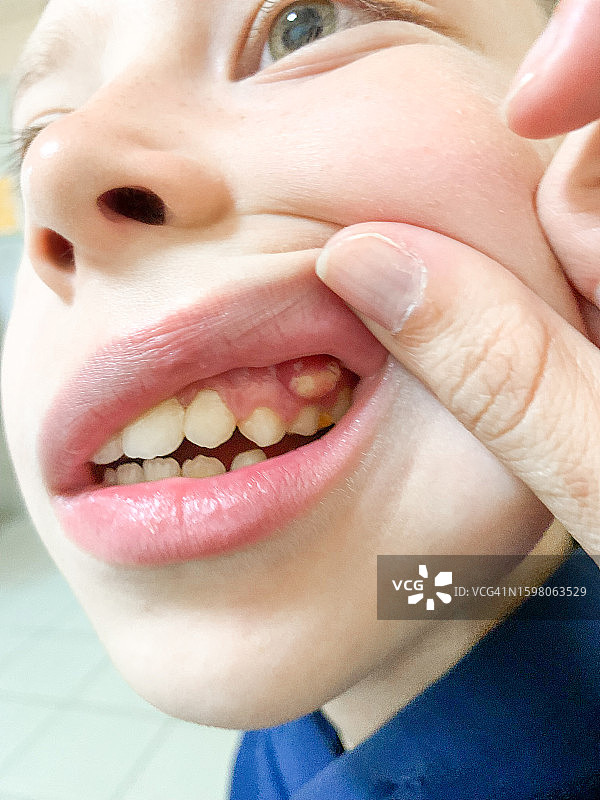 11岁男孩牙齿上的脓性瘘管特写图片素材