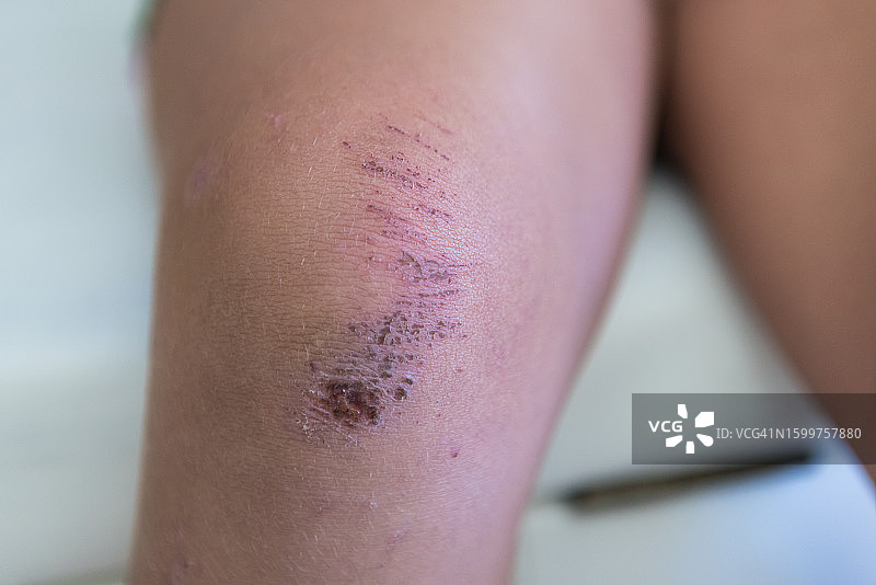 有伤口和结痂的膝盖：关于损伤和愈合图片素材