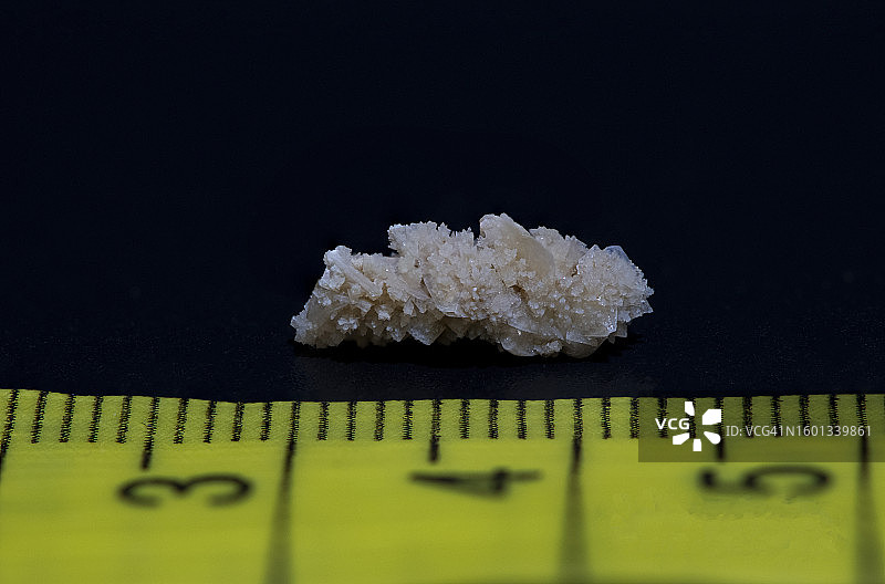 8毫米人体肾结石图片素材