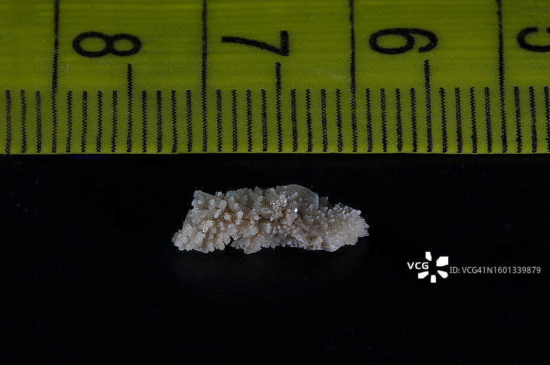 8毫米人体肾结石图片素材