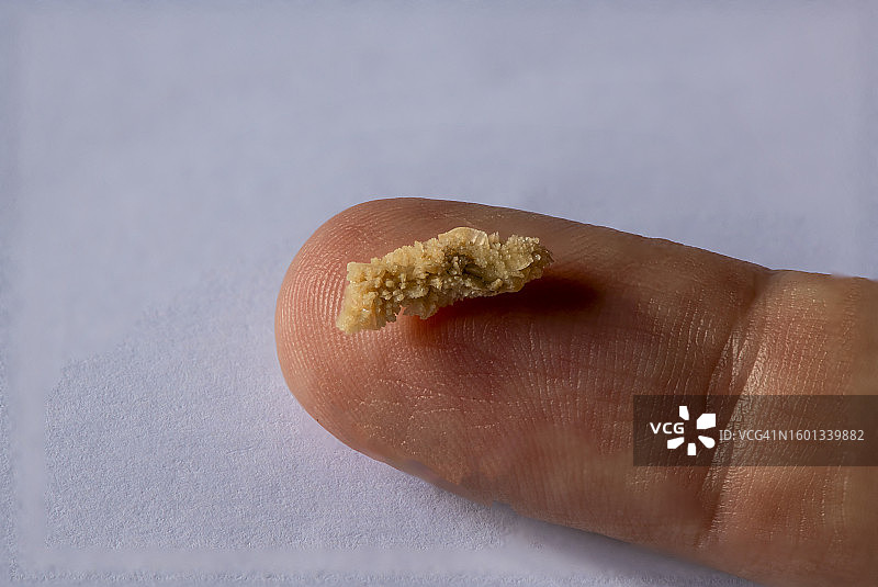 手指上的8毫米人体肾结石图片素材