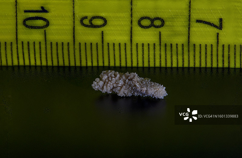 8毫米人体肾结石图片素材