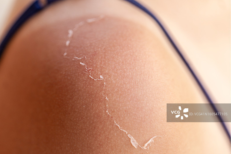 紫外线晒伤后脱皮的皮肤特写图片素材