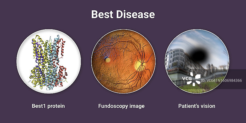 卵黄样黄斑营养不良插图图片素材