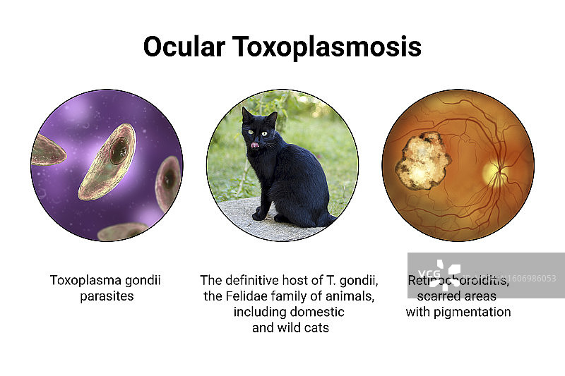 眼弓形虫病插图图片素材