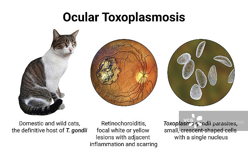 眼弓形虫病插图图片素材