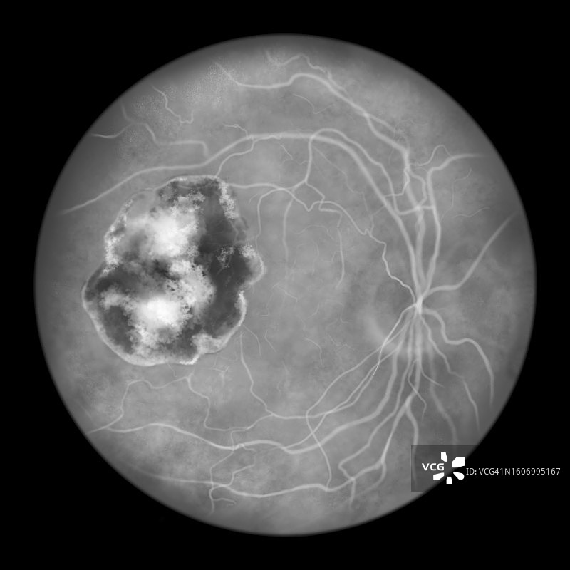 弓形虫病引起的视网膜疤痕插图图片素材