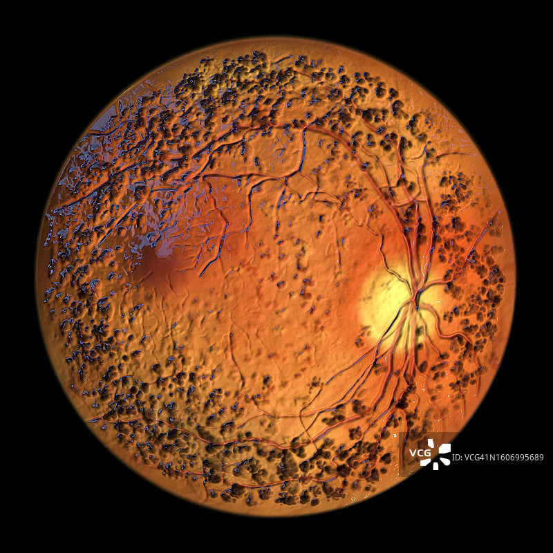 常染色体显性玻璃体视网膜脉络膜病变，图示图片素材