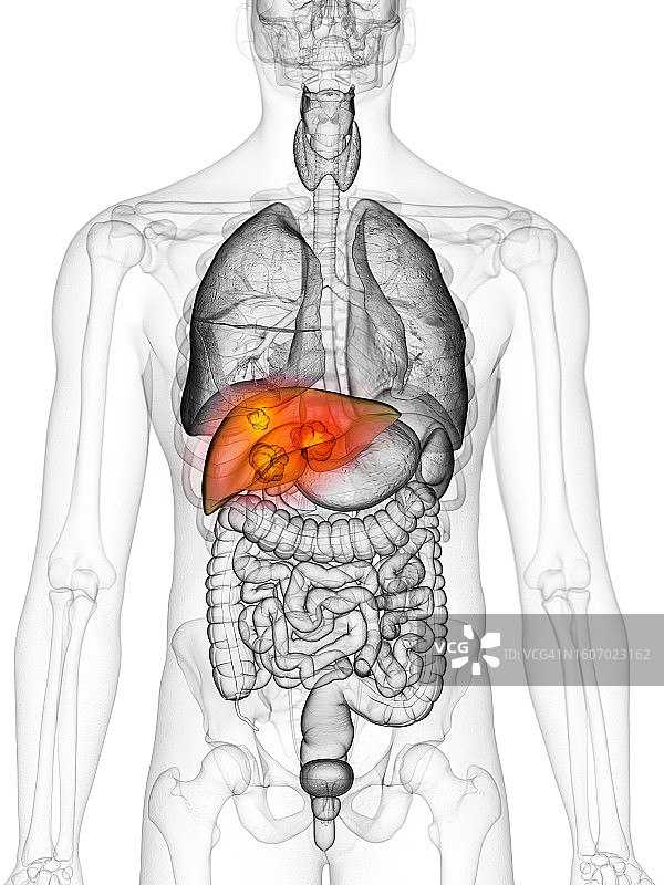 肝癌，图示图片素材