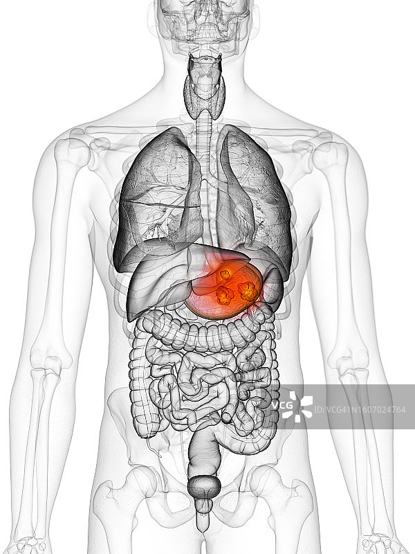 胃癌插图图片素材