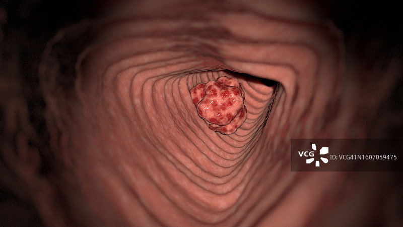 结肠癌，图示图片素材