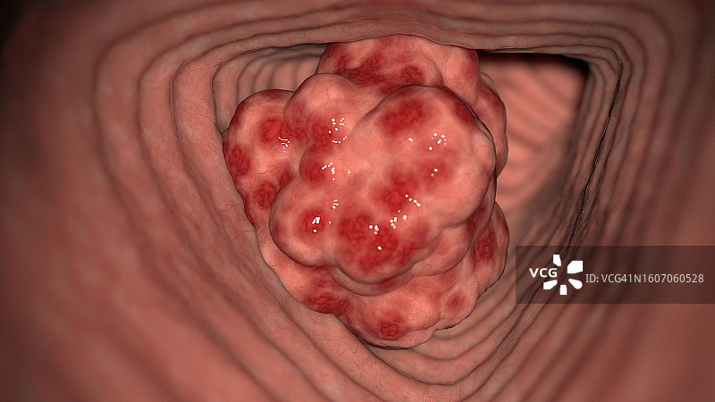 结肠癌，图示图片素材