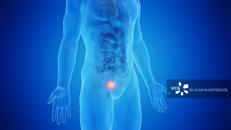 膀胱癌插图图片素材