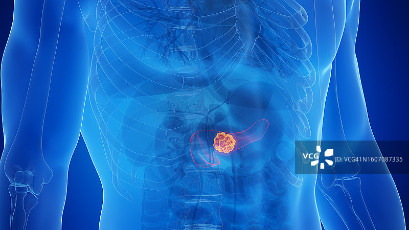 胰腺癌示意图图片素材