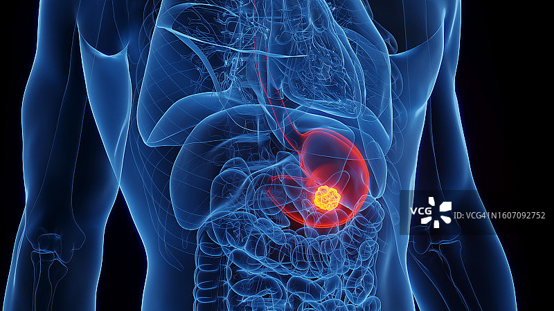 胃癌插图图片素材