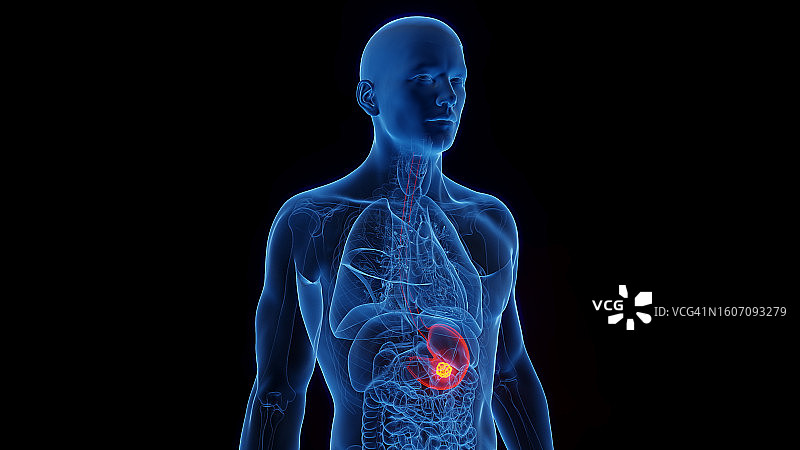 胃癌插图图片素材