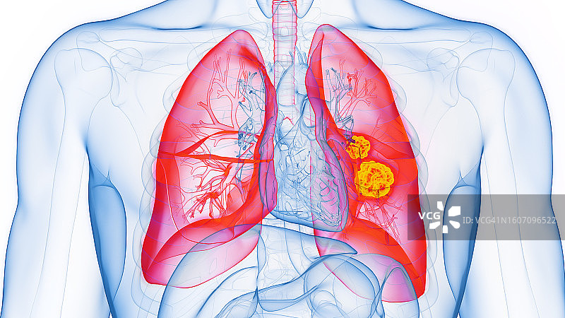 肺癌插图图片素材