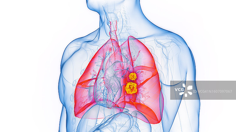 肺癌插图图片素材