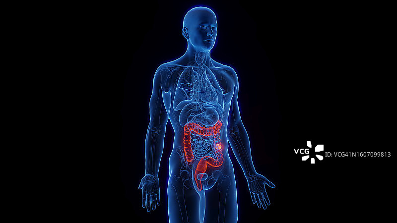 结肠癌，图示图片素材