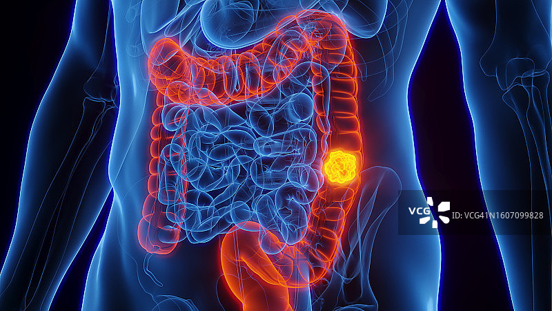 结肠癌，图示图片素材