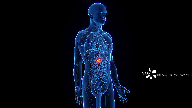 胰腺癌示意图图片素材