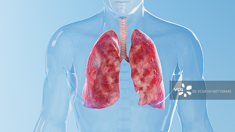 发炎的肺部，图示图片素材