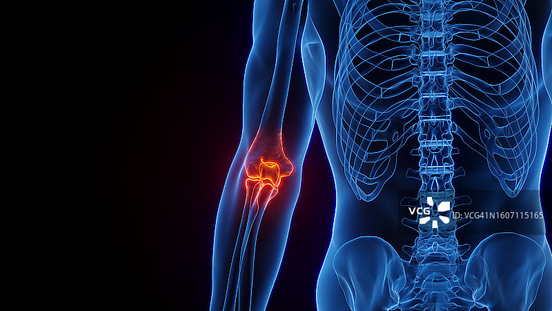 发炎的肘部，图示图片素材