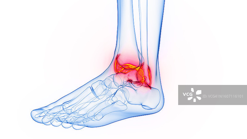 发炎的脚踝，插图图片素材