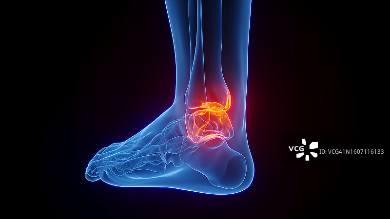 发炎的脚踝，插图图片素材