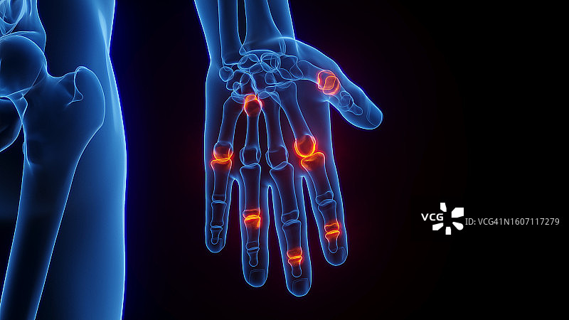 手部炎症插图图片素材