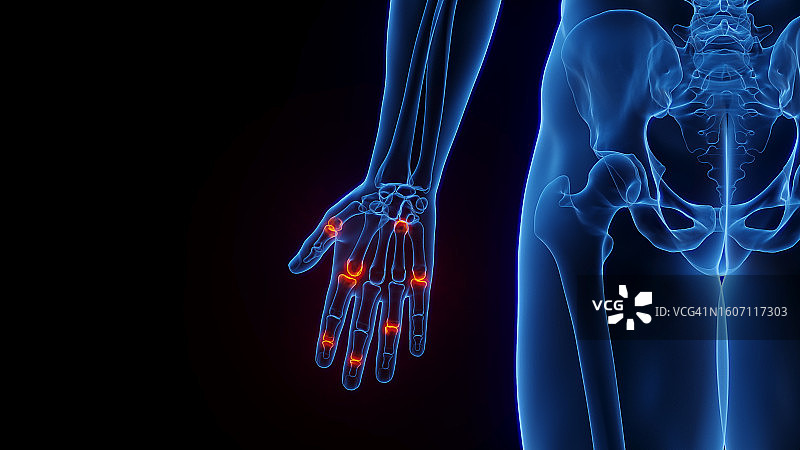 手部炎症插图图片素材