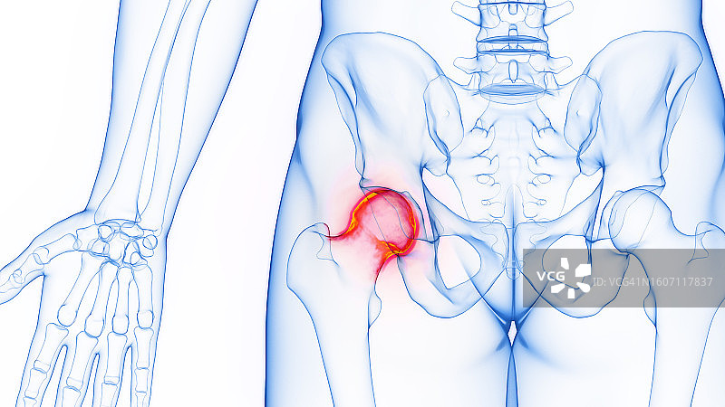 髋关节炎症插图图片素材