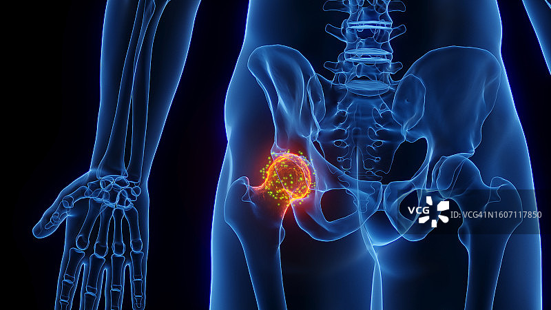 髋关节炎症愈合插图图片素材