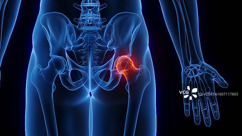 髋关节炎症插图图片素材