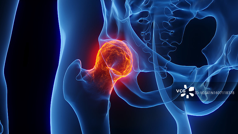 髋关节炎症插图图片素材