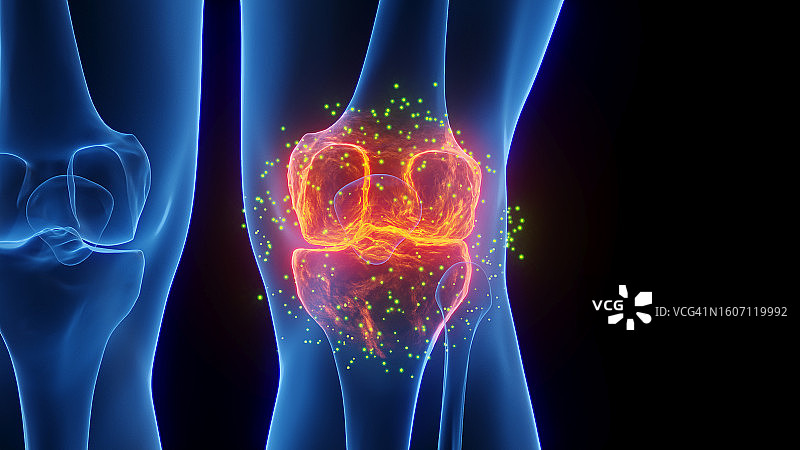 发炎的膝盖愈合插图图片素材