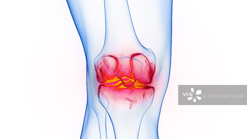 膝盖炎症插图图片素材