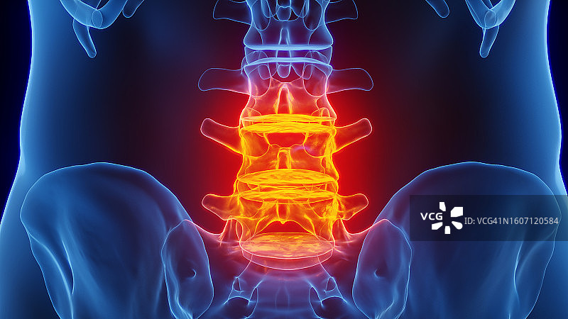 腰椎炎症插图图片素材