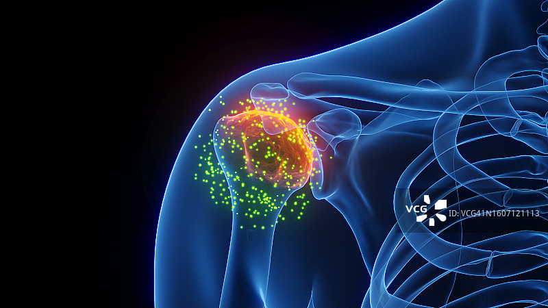 发炎的肩关节愈合插图图片素材