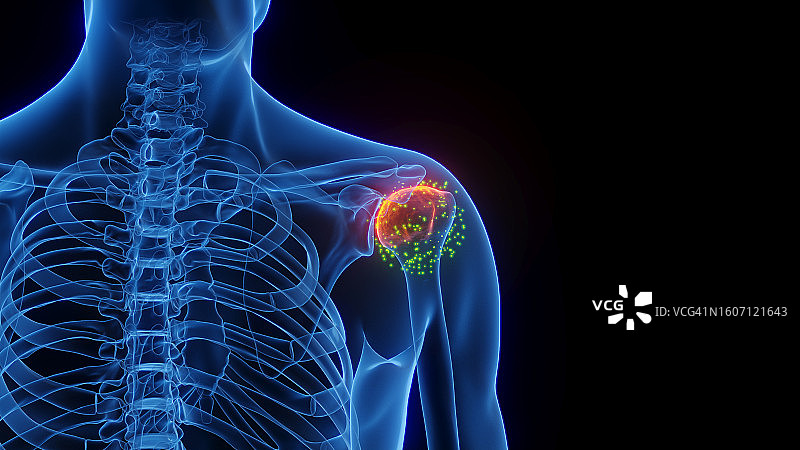 发炎的肩关节愈合插图图片素材