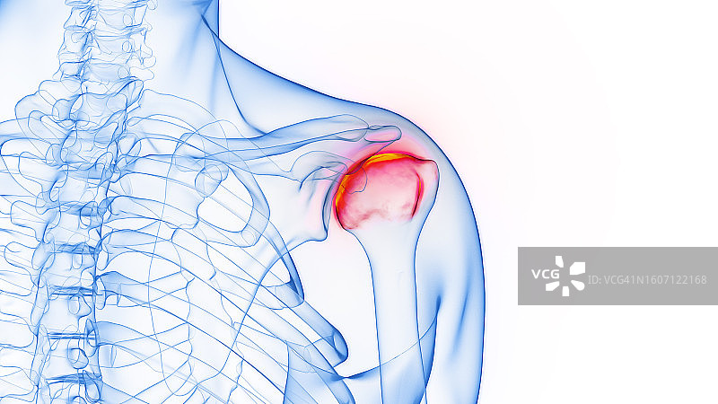 肩关节炎症插图图片素材
