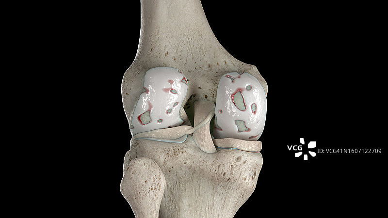 受损的膝盖软骨插图图片素材