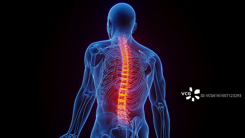 脊柱炎症插图图片素材