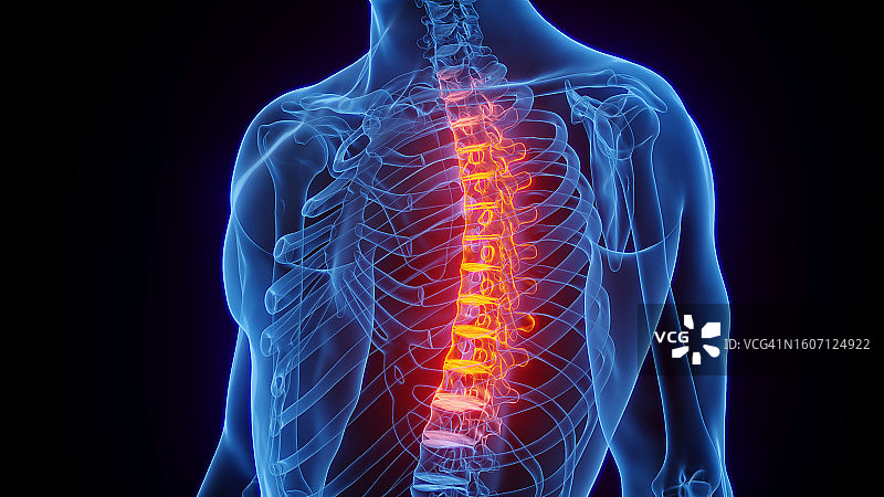胸椎炎症插图图片素材