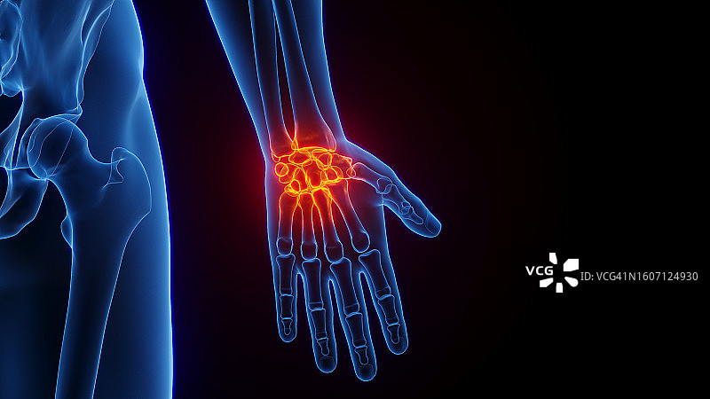 手腕炎症插画图片素材