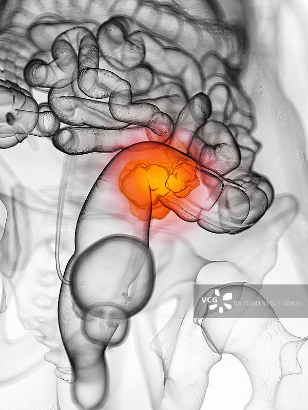 结直肠癌，图示图片素材